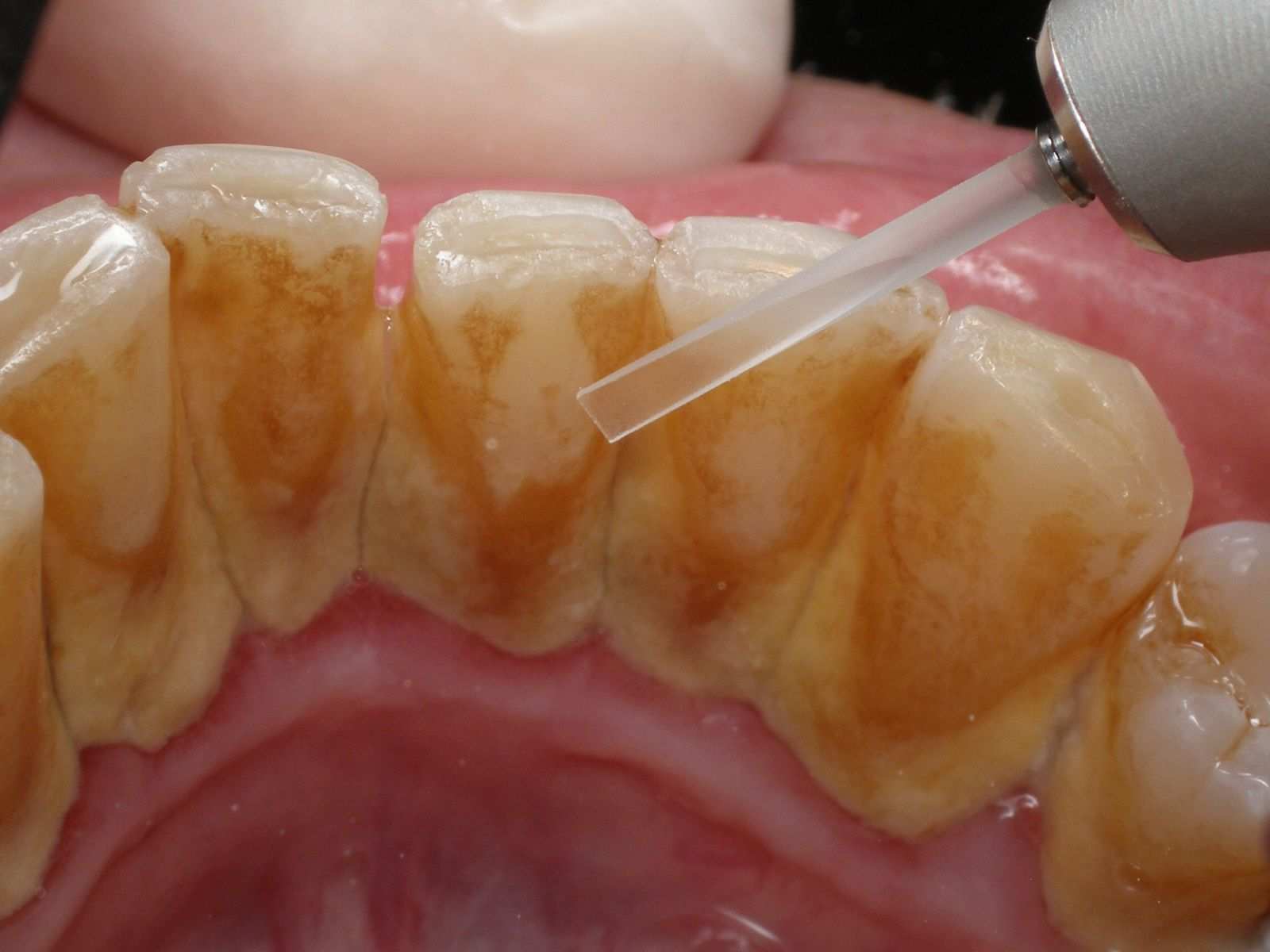 dental calculus before and after